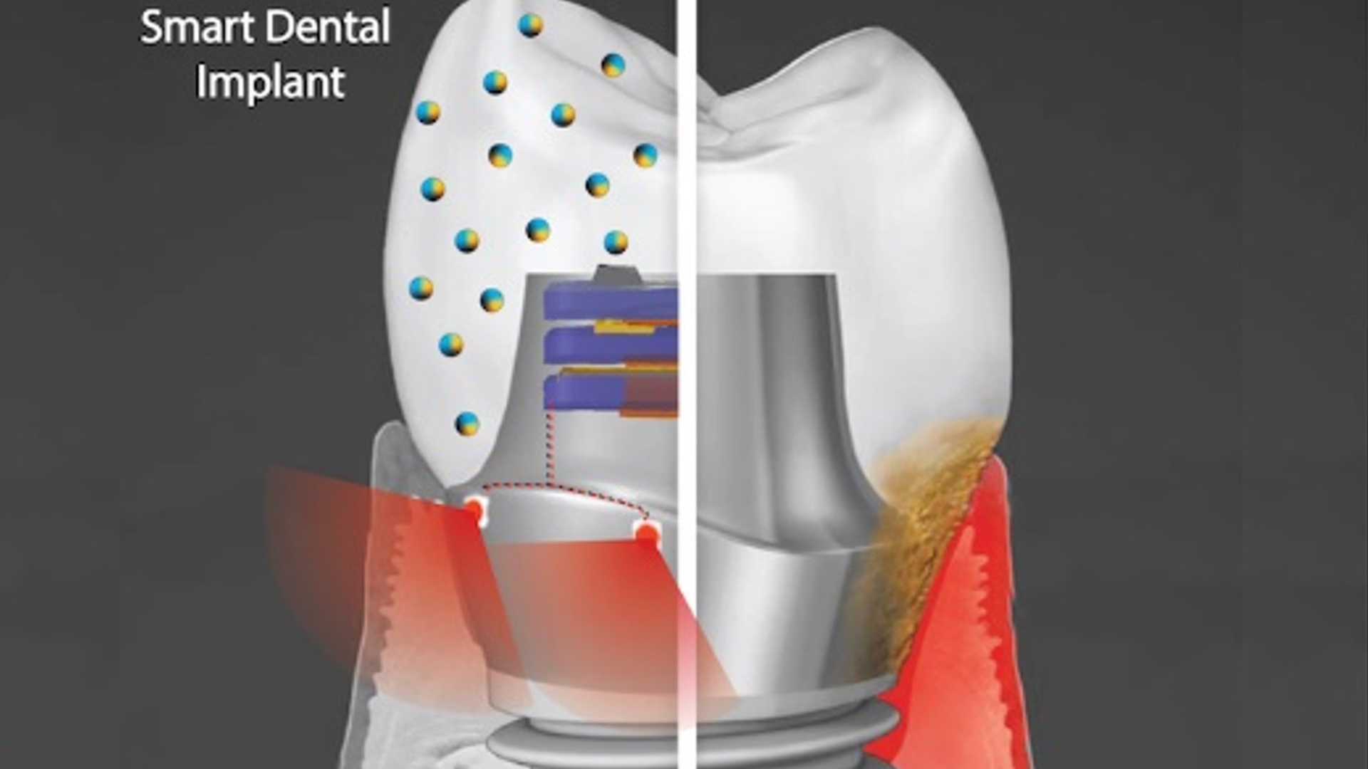 Smart Dental Implants That Resist Bacterial Growth - Healthcare Radius