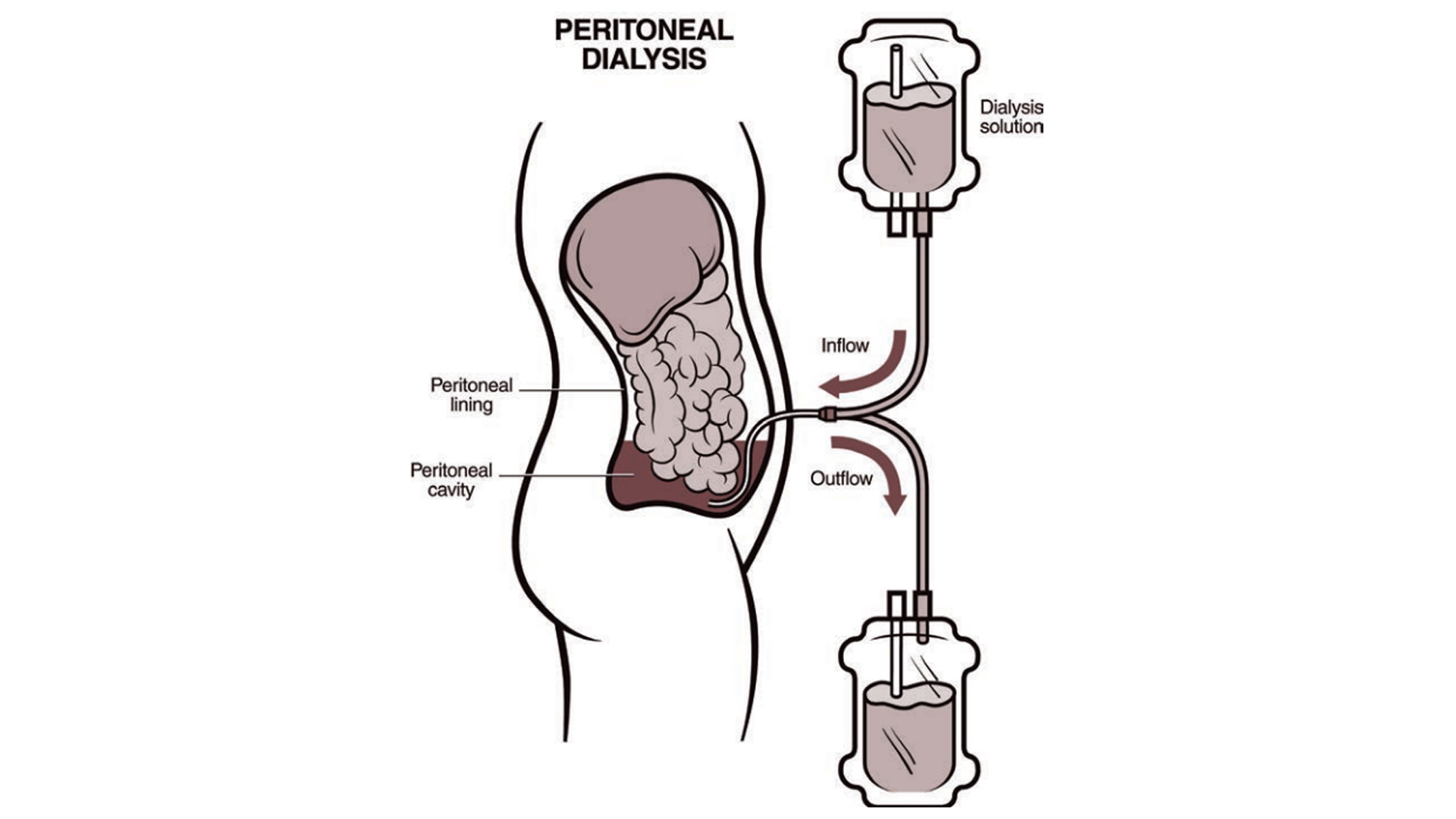 Easy and affordable access to Peritoneal Dialysis under PMNDP