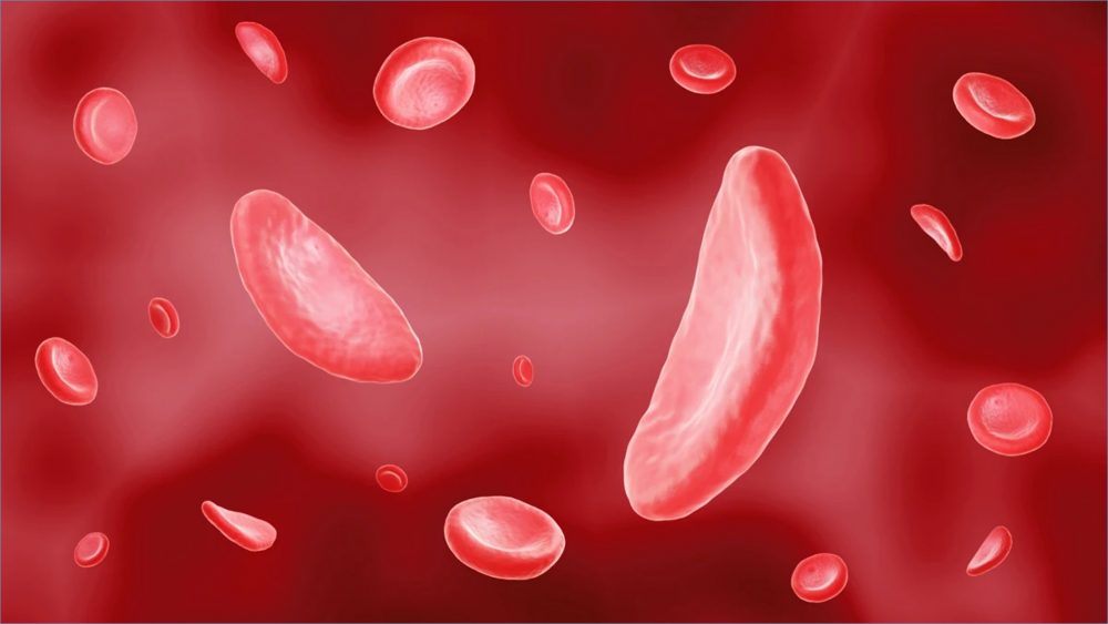 India is estimated to have the second-highest burden of sickle cell ...