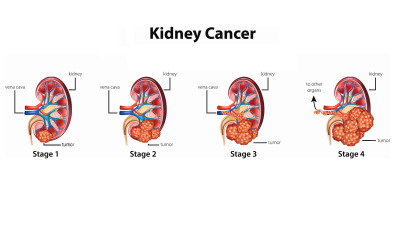 Manage complex kidney cancer with robot-assisted partial nephrectomy ...